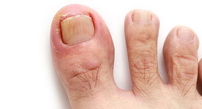 What Essential Oil Is Good For Toenail Fungus