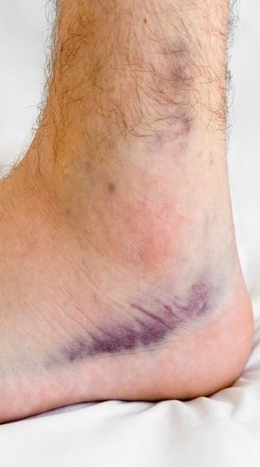 sprains_strains