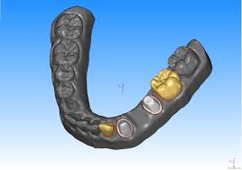cad cam bridge