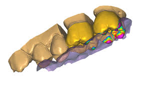 cad cam crown design