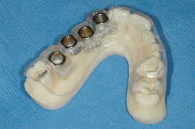 implant surgical guide