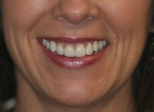 smile after 2