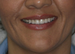 smile after 1
