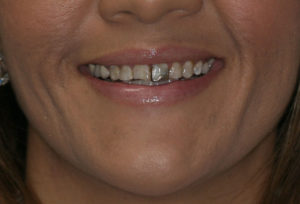 smile before 10
