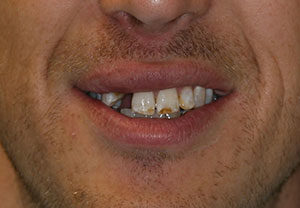 smile before 2