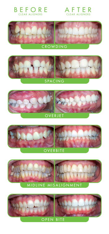 all before and after smiles