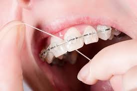 Flossing with Braces