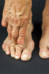 hammertoe
