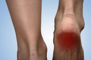 heel pain